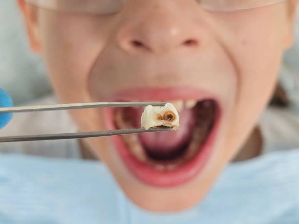 Emergency Dental Filling Replacement in DE